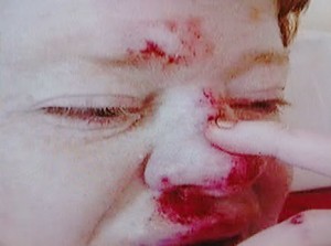 Vivienne Peoples with injuries her family claim she sustained while staying in Belmont Cottages.
