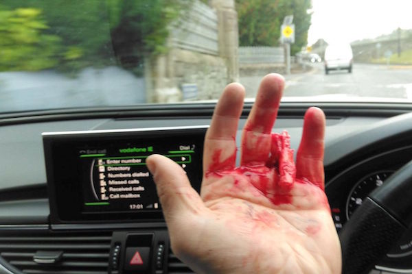Kevin McHugh's badly severed finger.